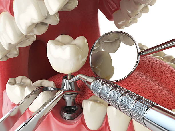 Best Knocked-Out Tooth (Avulsed Tooth) Treatment in Kirby, TX